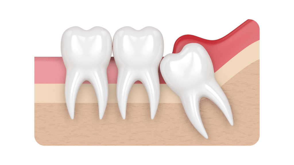 10 Things To Do When Recovering From Wisdom Teeth Surgery. 1 wisdom teeth