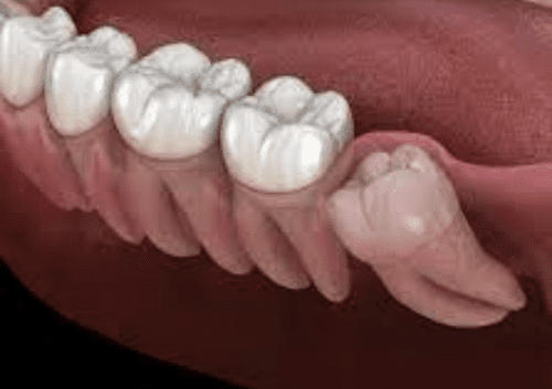 10 Things To Do When Recovering From Wisdom Teeth Surgery. 2 wisdom teeth