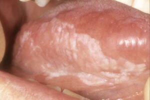 DO YOU HAVE PAINFUL WHITE SPOTS ON YOUR TONGUE OR MOUTH IN SUMMERLIN? 2 T4-300x200 (1)