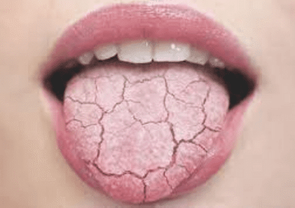 dry tongue