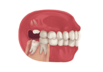 Illustration of a jaw