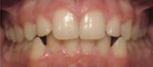 Patient 1 Before