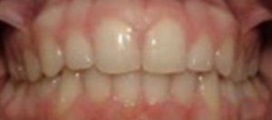 Patient 1 After