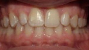 Patient 2 After