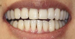 Patient 6 After