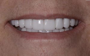 Patient 5 After