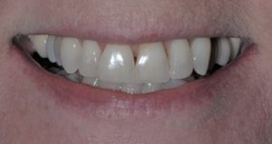 Patient 6 Before