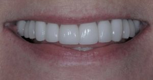 Patient 6 After