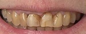 Patient 1 Before