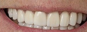 Patient 1 After