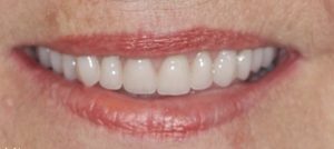 Patient 4 After