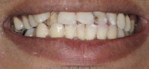 Patient 8 Before