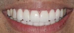 Patient 8 After