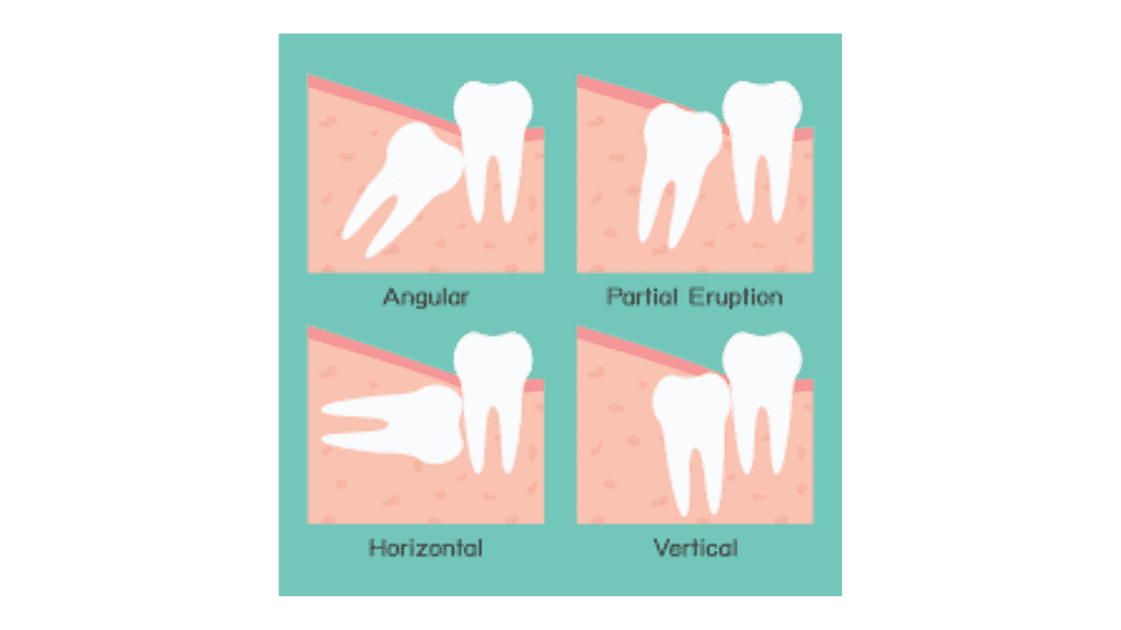 <strong>Am I Too Old to Have My Wisdom Teeth Extracted?</strong><strong></strong> 2 wisdom teeth