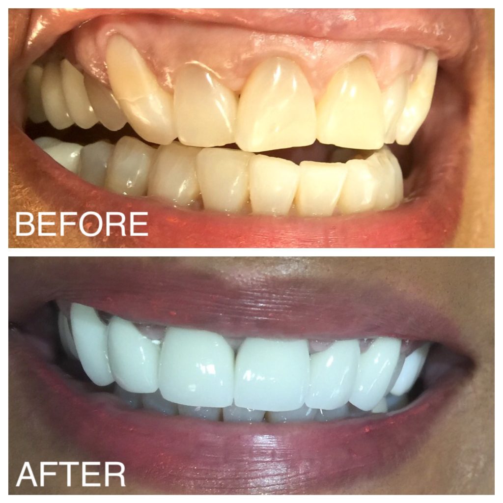 Three (3) Things to Consider During a Smile Makeover 1 smile makeover