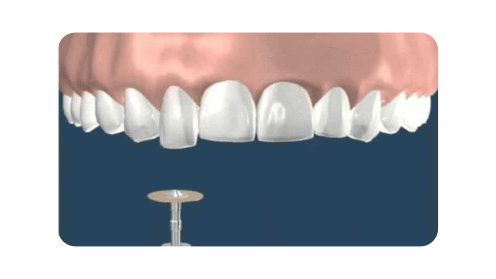 <strong>Tooth Recontouring Offers Fast Aesthetic Results</strong><strong></strong> 1 tooth recontouring