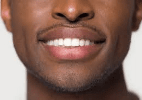 <strong>Can You Get a Facelift with Porcelain Veneers?</strong><strong></strong> 2 veneers