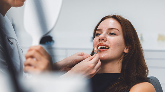 Veneers
