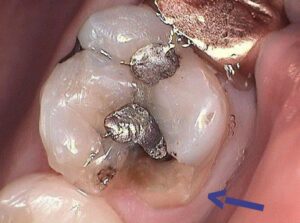 IMG_9955.jpg-BETTER-CRACKED-TOOTH-300x223
