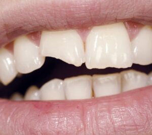 IMG_9957.jpg-CHIPPED-TOOTH-300x267
