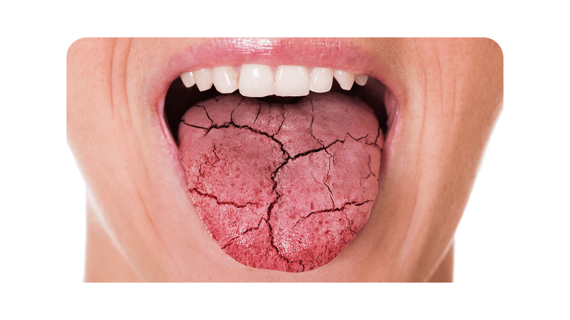Dry Mouth Las Vegas Summerlin Dental Solutions