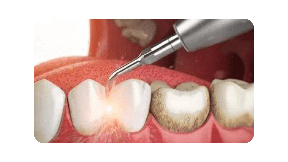 Teeth Cleaning, Dental Deep Cleaning Summerlin Dental Solutions